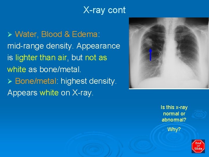 X-ray cont Water, Blood & Edema: mid-range density. Appearance is lighter than air, but