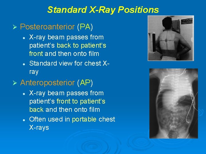 Standard X-Ray Positions Ø Posteroanterior (PA) l l Ø X-ray beam passes from patient’s