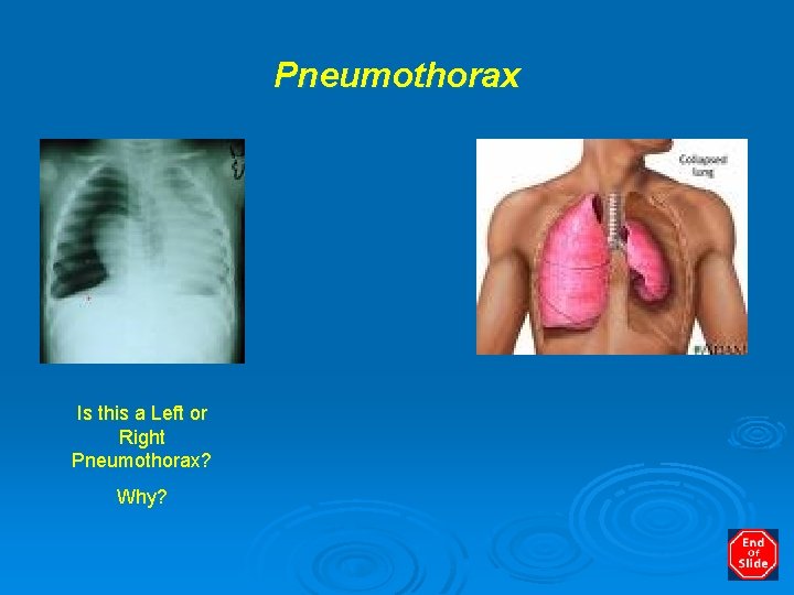 Pneumothorax Is this a Left or Right Pneumothorax? Why? 