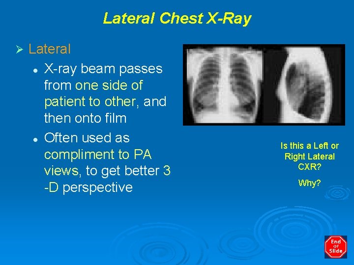 Lateral Chest X-Ray Ø Lateral l X-ray beam passes from one side of patient