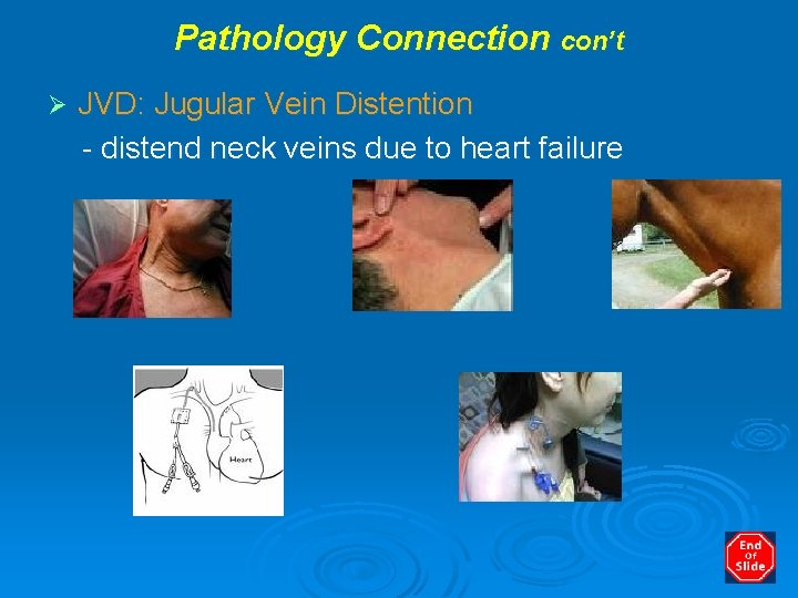 Pathology Connection con’t Ø JVD: Jugular Vein Distention - distend neck veins due to