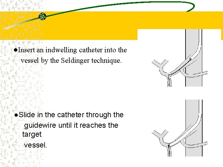 ●Insert an indwelling catheter into the vessel by the Seldinger technique. ●Slide in the