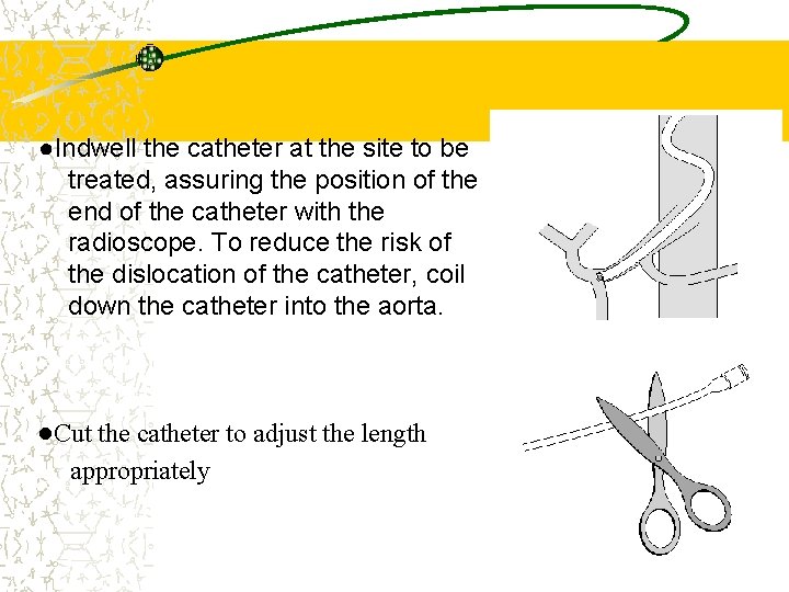 ●Indwell the catheter at the site to be treated, assuring the position of the