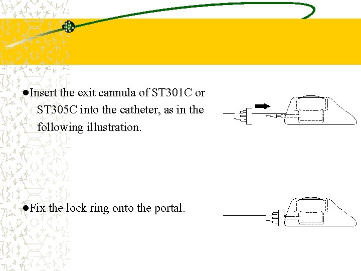 ●Insert the exit cannula of ST 301 C or ST 305 C into the