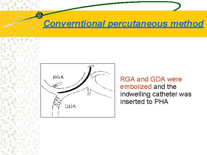 Converntional percutaneous method RGA and GDA were embolized and the indwelling catheter was inserted