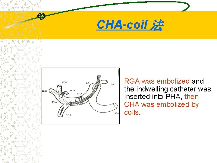 CHA-coil 法 RGA was embolized and the indwelling catheter was inserted into PHA, then