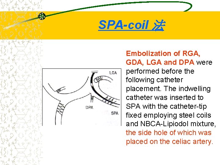 SPA-coil 法 Embolization of RGA, GDA, LGA and DPA were performed before the following