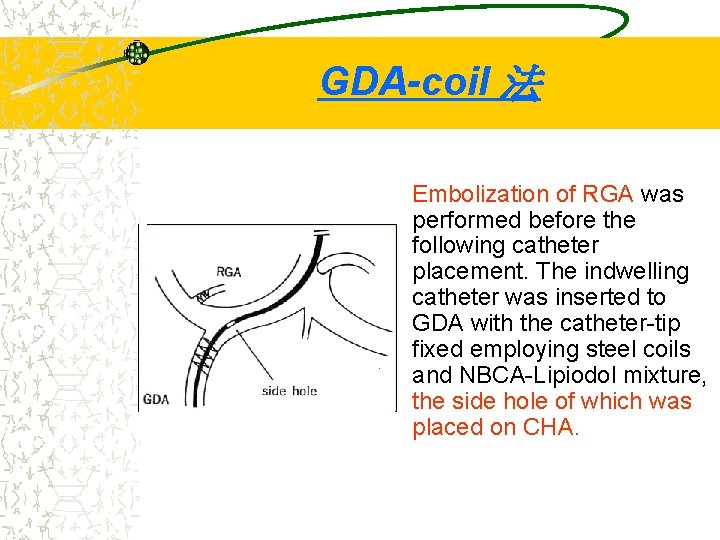 GDA-coil 法 Embolization of RGA was performed before the following catheter placement. The indwelling