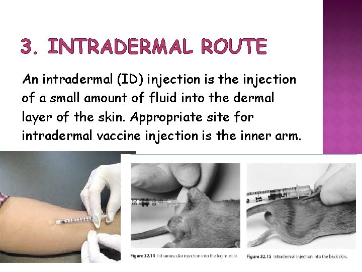 3. INTRADERMAL ROUTE An intradermal (ID) injection is the injection of a small amount