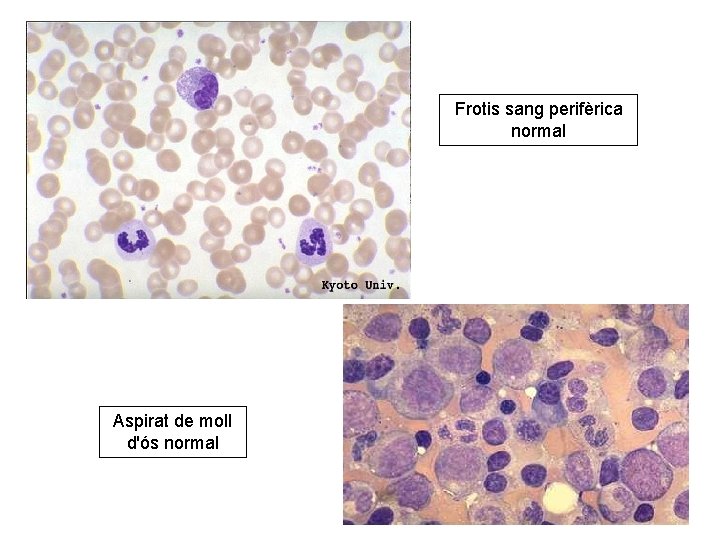 Frotis sang perifèrica normal Aspirat de moll d'ós normal 