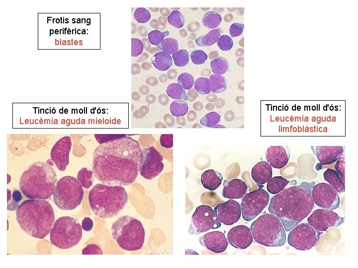 Frotis sang perifèrica: blastes Tinció de moll d'ós: Leucèmia aguda mieloide Tinció de moll
