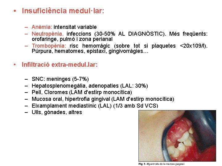  • Insuficiència medul·lar: – Anèmia: intensitat variable – Neutropènia. infeccions (30 -50% AL