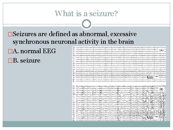 What is a seizure? �Seizures are defined as abnormal, excessive synchronous neuronal activity in