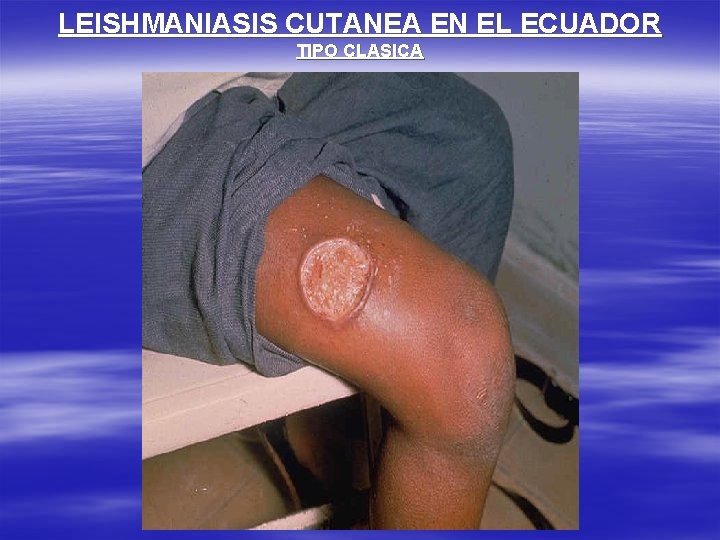 LEISHMANIASIS CUTANEA EN EL ECUADOR TIPO CLASICA 