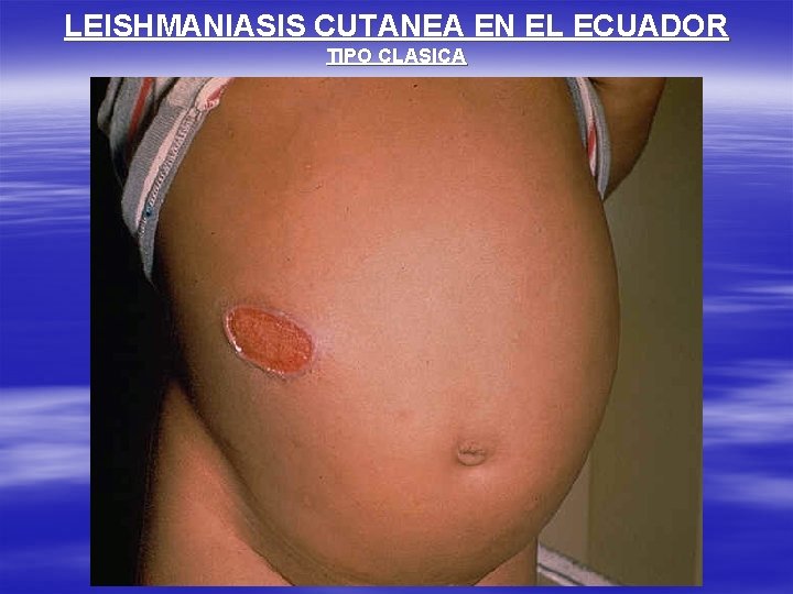 LEISHMANIASIS CUTANEA EN EL ECUADOR TIPO CLASICA 