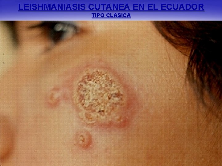 LEISHMANIASIS CUTANEA EN EL ECUADOR TIPO CLASICA 