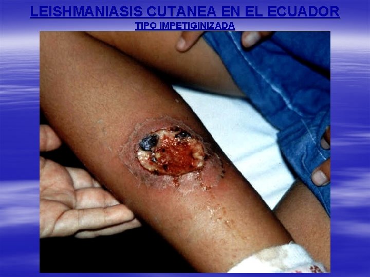 LEISHMANIASIS CUTANEA EN EL ECUADOR TIPO IMPETIGINIZADA 