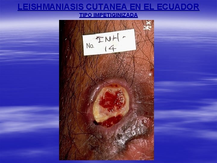 LEISHMANIASIS CUTANEA EN EL ECUADOR TIPO IMPETIGINIZADA 