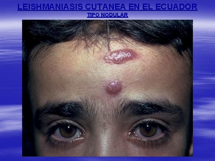 LEISHMANIASIS CUTANEA EN EL ECUADOR TIPO NODULAR 