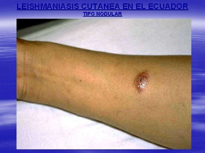 LEISHMANIASIS CUTANEA EN EL ECUADOR TIPO NODULAR 