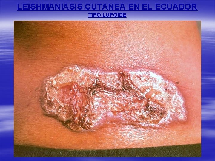 LEISHMANIASIS CUTANEA EN EL ECUADOR TIPO LUPOIDE 