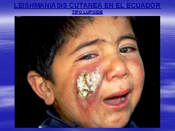 LEISHMANIASIS CUTANEA EN EL ECUADOR TIPO LUPOIDE 