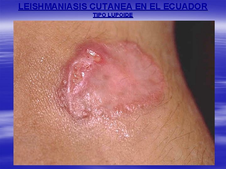 LEISHMANIASIS CUTANEA EN EL ECUADOR TIPO LUPOIDE 