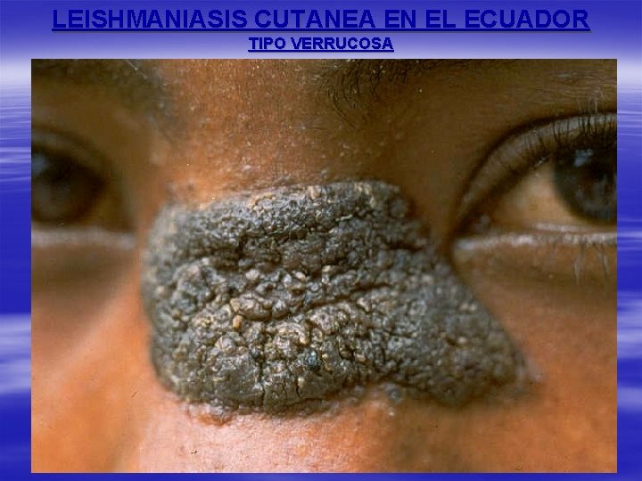 LEISHMANIASIS CUTANEA EN EL ECUADOR TIPO VERRUCOSA 