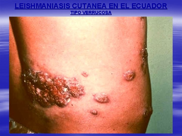 LEISHMANIASIS CUTANEA EN EL ECUADOR TIPO VERRUCOSA 