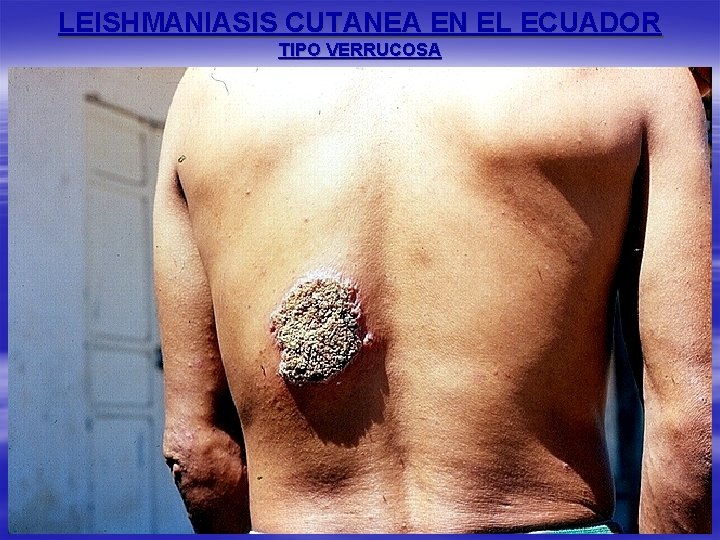 LEISHMANIASIS CUTANEA EN EL ECUADOR TIPO VERRUCOSA 