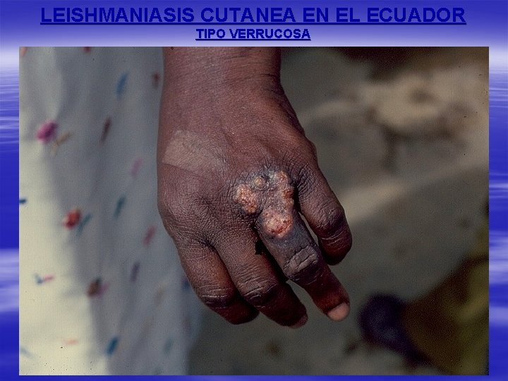 LEISHMANIASIS CUTANEA EN EL ECUADOR TIPO VERRUCOSA 
