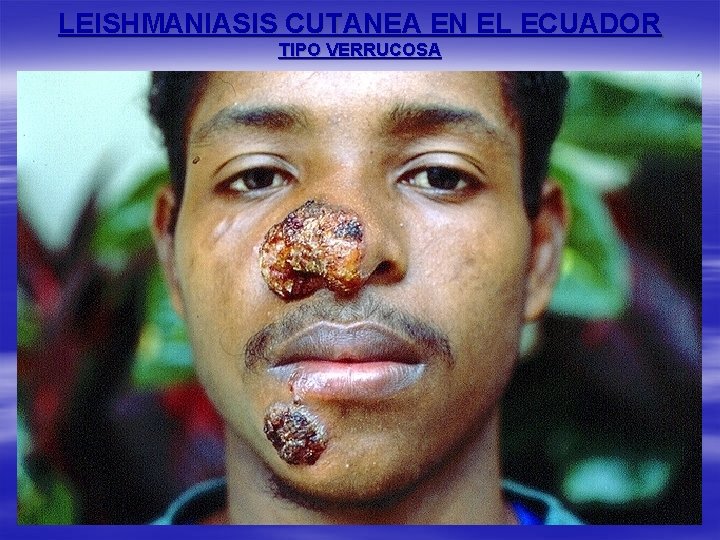 LEISHMANIASIS CUTANEA EN EL ECUADOR TIPO VERRUCOSA 