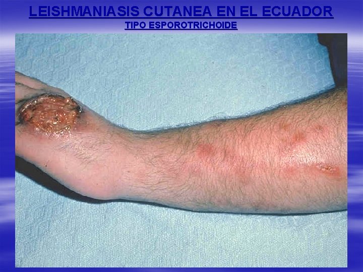 LEISHMANIASIS CUTANEA EN EL ECUADOR TIPO ESPOROTRICHOIDE 