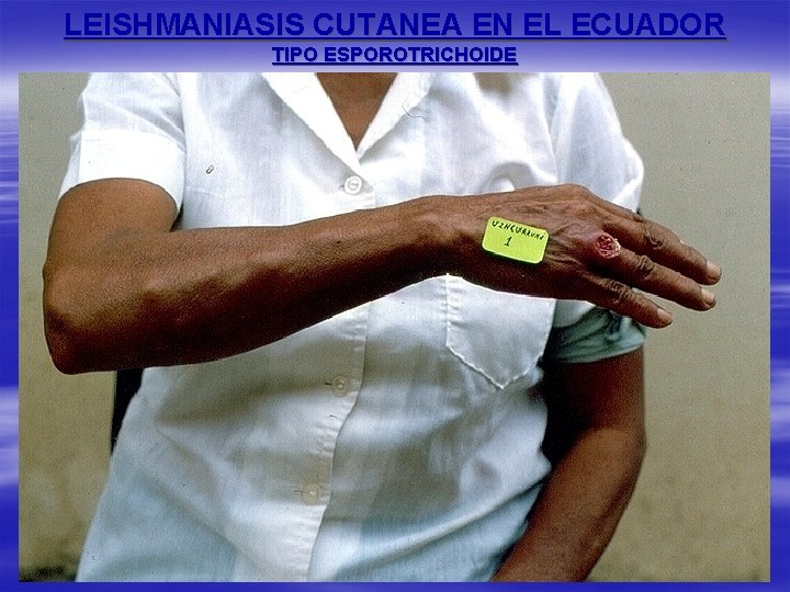 LEISHMANIASIS CUTANEA EN EL ECUADOR TIPO ESPOROTRICHOIDE 