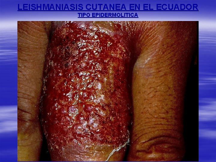 LEISHMANIASIS CUTANEA EN EL ECUADOR TIPO EPIDERMOLITICA 