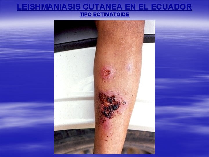 LEISHMANIASIS CUTANEA EN EL ECUADOR TIPO ECTIMATOIDE 