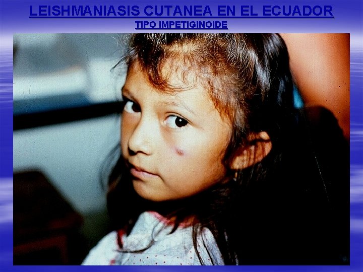 LEISHMANIASIS CUTANEA EN EL ECUADOR TIPO IMPETIGINOIDE 