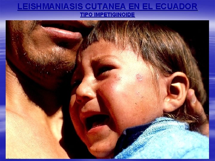 LEISHMANIASIS CUTANEA EN EL ECUADOR TIPO IMPETIGINOIDE 