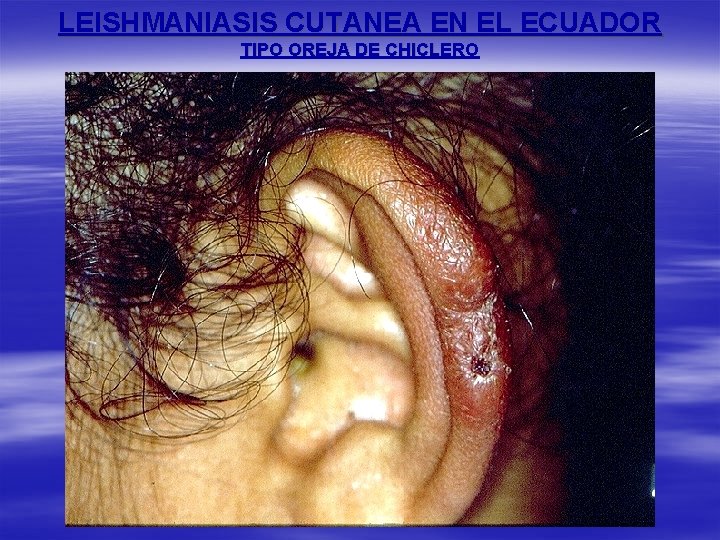 LEISHMANIASIS CUTANEA EN EL ECUADOR TIPO OREJA DE CHICLERO 