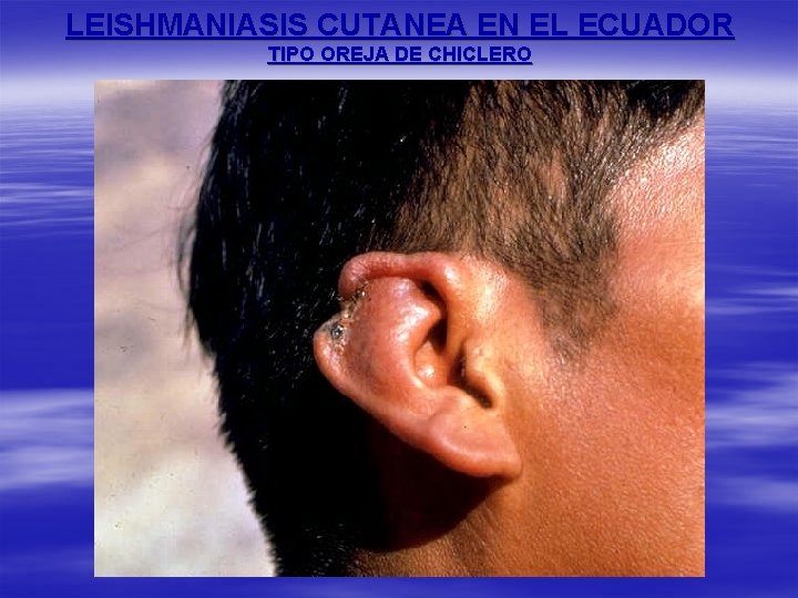 LEISHMANIASIS CUTANEA EN EL ECUADOR TIPO OREJA DE CHICLERO 