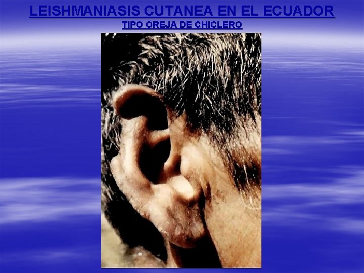 LEISHMANIASIS CUTANEA EN EL ECUADOR TIPO OREJA DE CHICLERO 