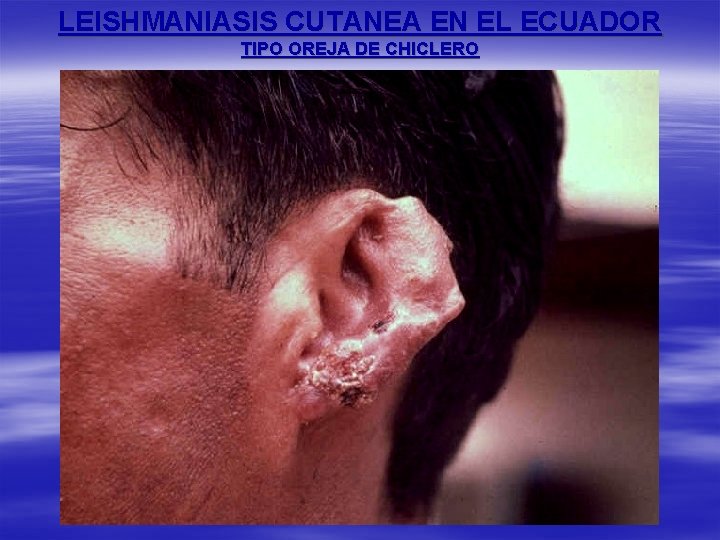 LEISHMANIASIS CUTANEA EN EL ECUADOR TIPO OREJA DE CHICLERO 
