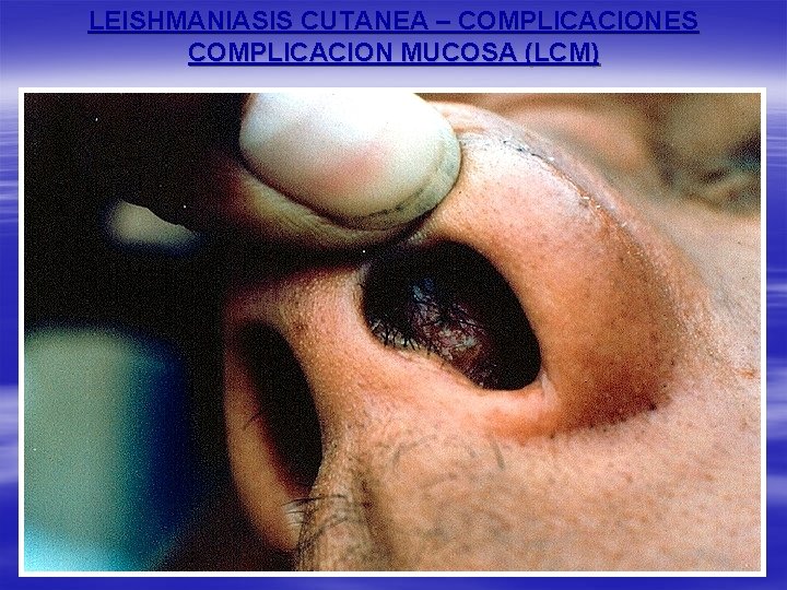 LEISHMANIASIS CUTANEA – COMPLICACIONES COMPLICACION MUCOSA (LCM) 