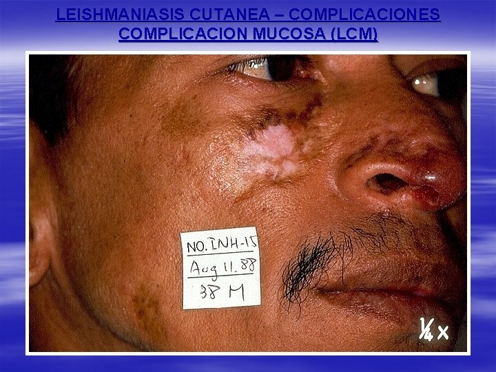 LEISHMANIASIS CUTANEA – COMPLICACIONES COMPLICACION MUCOSA (LCM) 