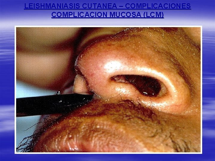 LEISHMANIASIS CUTANEA – COMPLICACIONES COMPLICACION MUCOSA (LCM) 