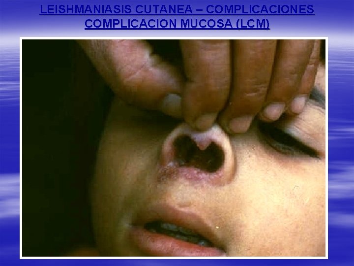 LEISHMANIASIS CUTANEA – COMPLICACIONES COMPLICACION MUCOSA (LCM) 