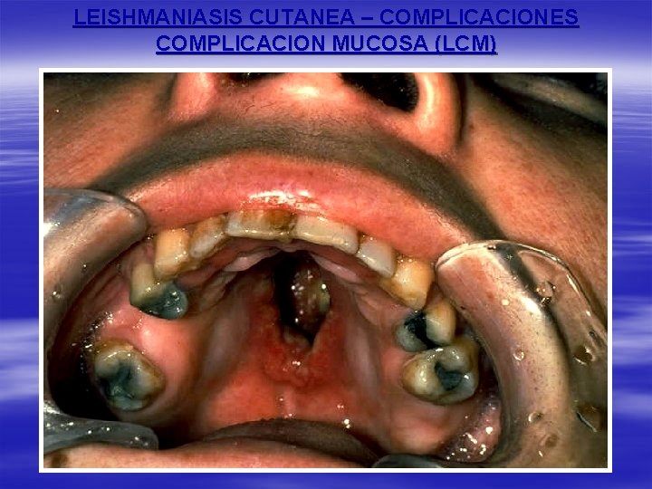 LEISHMANIASIS CUTANEA – COMPLICACIONES COMPLICACION MUCOSA (LCM) 