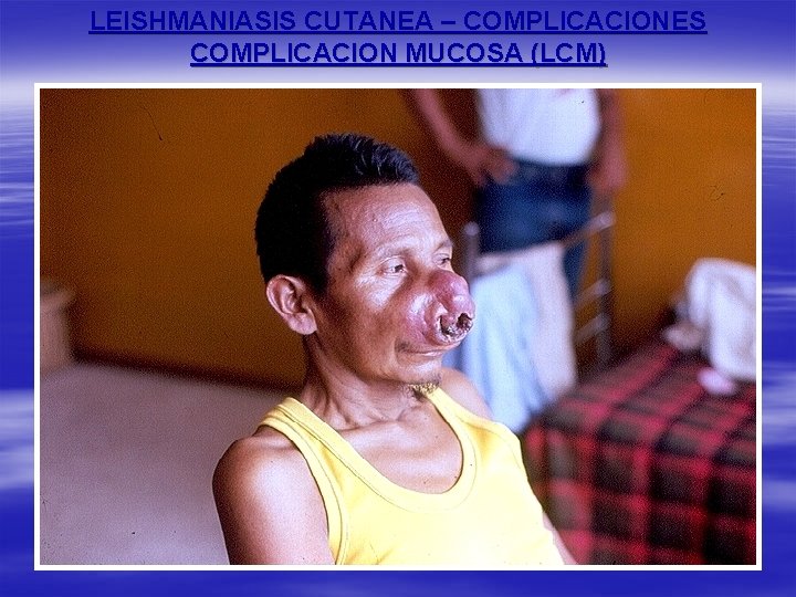 LEISHMANIASIS CUTANEA – COMPLICACIONES COMPLICACION MUCOSA (LCM) 