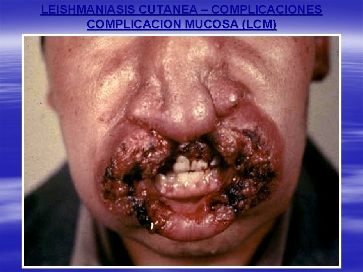 LEISHMANIASIS CUTANEA – COMPLICACIONES COMPLICACION MUCOSA (LCM) 