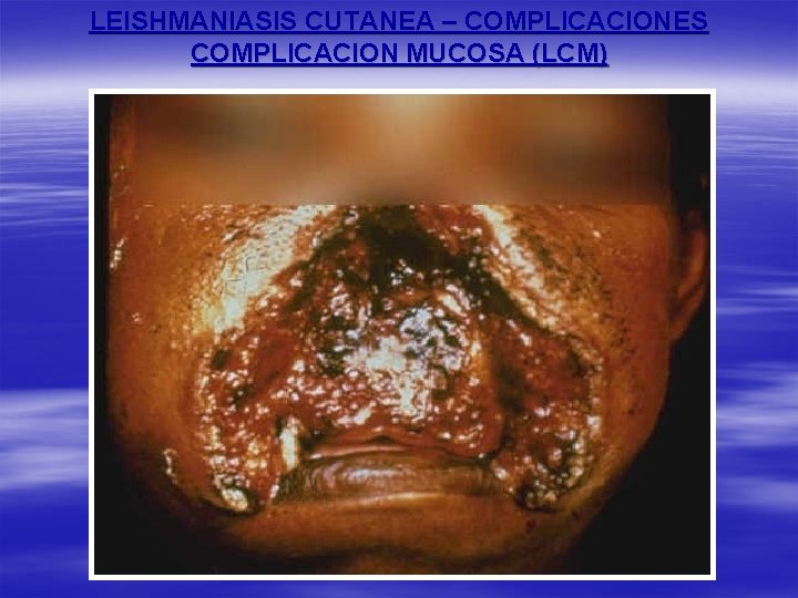 LEISHMANIASIS CUTANEA – COMPLICACIONES COMPLICACION MUCOSA (LCM) 